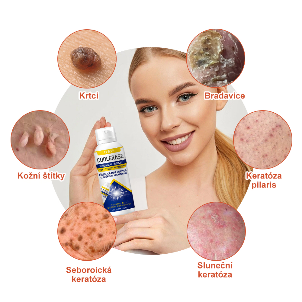 FFBSI® CoolErase Sprej pro regeneraci pokožky (Bradavice, Puchýře, Ekzém, Lupy, Kožní keratózy, Akné, Kožní výrůstky, Jizvy, Mateřská znaménka)💎
