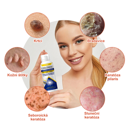 FFBSI® CoolErase Sprej pro regeneraci pokožky (Bradavice, Puchýře, Ekzém, Lupy, Kožní keratózy, Akné, Kožní výrůstky, Jizvy, Mateřská znaménka)💎