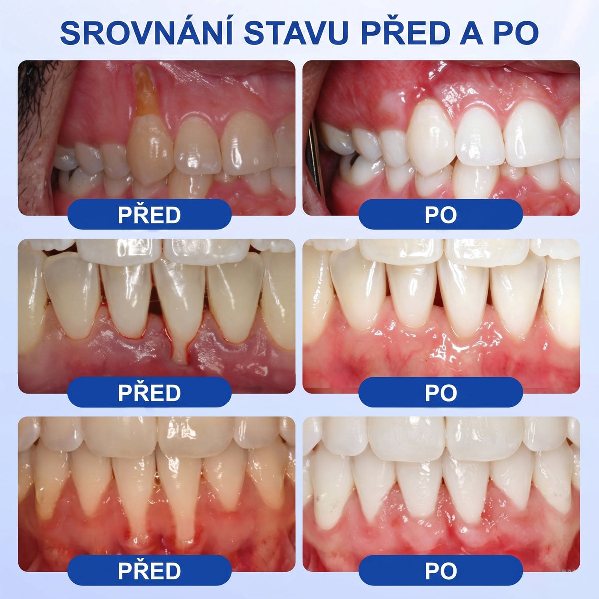 PureShade® 🦷 GumRevive regenerační gel na dásně