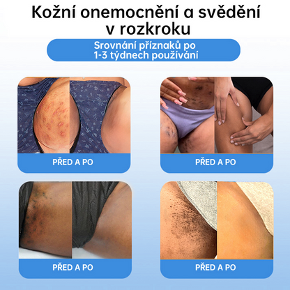 FFBSI® CoolErase Sprej pro regeneraci pokožky (Bradavice, Puchýře, Ekzém, Lupy, Kožní keratózy, Akné, Kožní výrůstky, Jizvy, Mateřská znaménka)💎