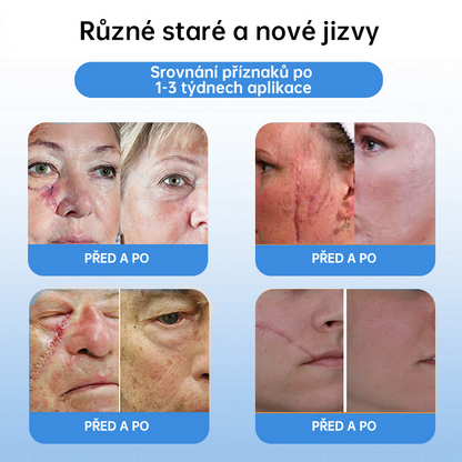 FFBSI® CoolErase Sprej pro regeneraci pokožky (Bradavice, Puchýře, Ekzém, Lupy, Kožní keratózy, Akné, Kožní výrůstky, Jizvy, Mateřská znaménka)💎