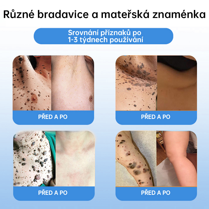 FFBSI® CoolErase Sprej pro regeneraci pokožky (Bradavice, Puchýře, Ekzém, Lupy, Kožní keratózy, Akné, Kožní výrůstky, Jizvy, Mateřská znaménka)💎