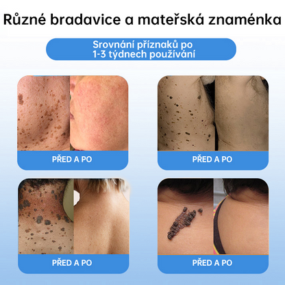 FFBSI® CoolErase Sprej pro regeneraci pokožky (Bradavice, Puchýře, Ekzém, Lupy, Kožní keratózy, Akné, Kožní výrůstky, Jizvy, Mateřská znaménka)💎