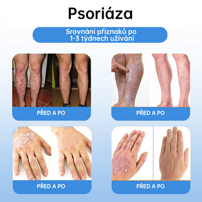 FFBSI® CoolErase Sprej pro regeneraci pokožky (Bradavice, Puchýře, Ekzém, Lupy, Kožní keratózy, Akné, Kožní výrůstky, Jizvy, Mateřská znaménka)💎