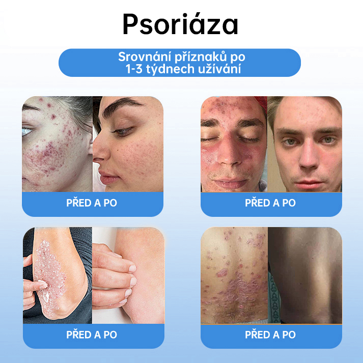 FFBSI® CoolErase Sprej pro regeneraci pokožky (Bradavice, Puchýře, Ekzém, Lupy, Kožní keratózy, Akné, Kožní výrůstky, Jizvy, Mateřská znaménka)💎