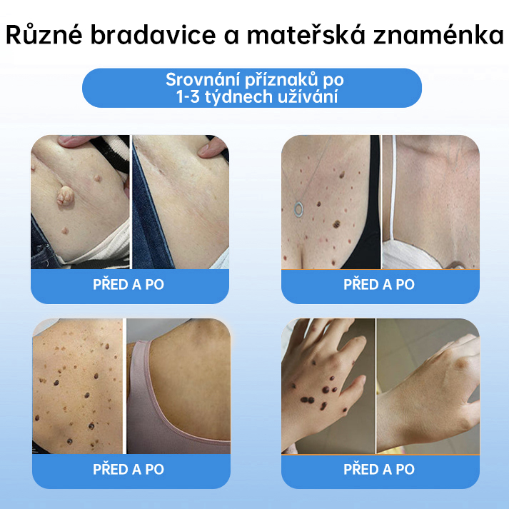 FFBSI® CoolErase Sprej pro regeneraci pokožky (Bradavice, Puchýře, Ekzém, Lupy, Kožní keratózy, Akné, Kožní výrůstky, Jizvy, Mateřská znaménka)💎