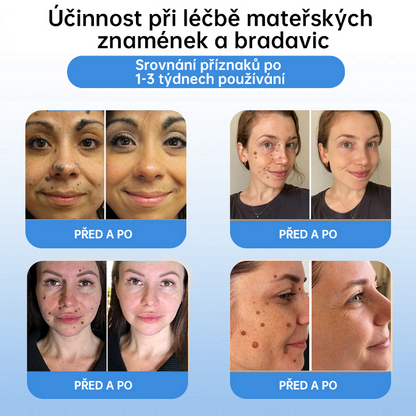 FFBSI® CoolErase Sprej pro regeneraci pokožky (Bradavice, Puchýře, Ekzém, Lupy, Kožní keratózy, Akné, Kožní výrůstky, Jizvy, Mateřská znaménka)💎