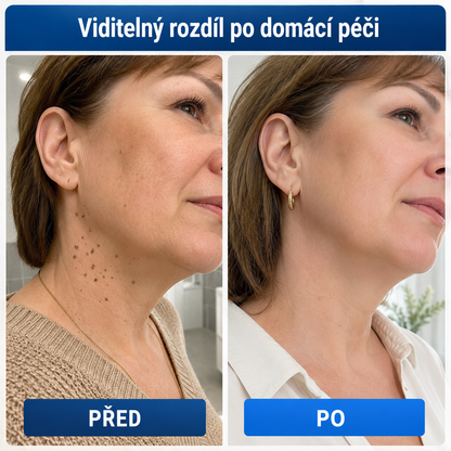 🎁 Oficiální značkový obchod🎁 Hiskin® 7denní odstraňovač skvrn a pigmentových skvrn